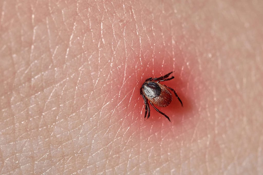 Sucking tick Macro photo on human skin Ixodes ricinus Bloated parasite bitten into pink irritated epidermis Small red drops Dangerous insect mite Encephalitis Lyme disease infection - NL Directo Garrapatas